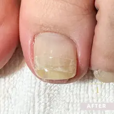 即見た目改善 nail23